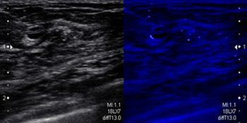 THOMAS JEFFERSON UNIVERSITY PILOT STUDY FINDS TOSHIBA’S ULTRASOUND TECHNOLOGY HELPS IMPROVE BREAST MICROCALCIFICATION VISUALIZATION